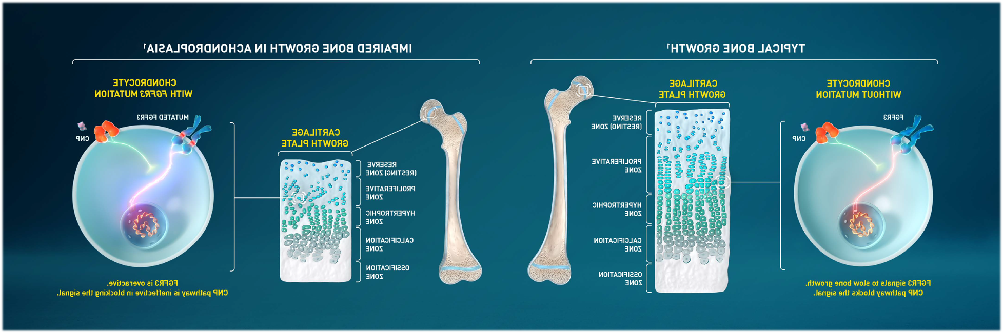 图片:正常骨生长vs. 软骨发育不全的骨骼生长